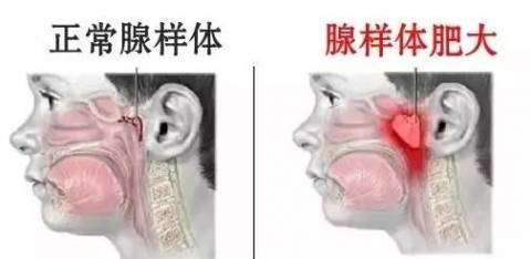 孩子睡觉张口,打鼾,原理是这里出了问题!