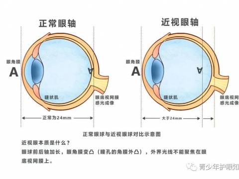 孩子近视度数没增加,眼轴为什么还在长?