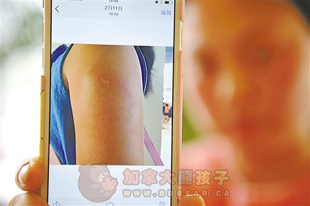 重庆7岁女童游泰国 拒尽男导游亲吻被咬伤