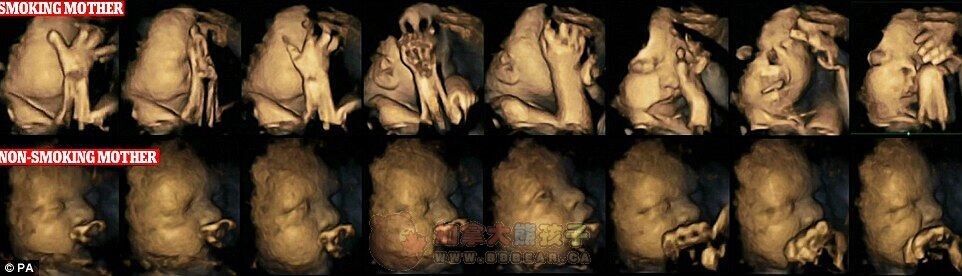 4D超声波扫描图缔造妊妇抽烟可致胎儿患病