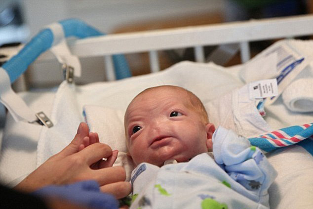 新生婴儿生成没鼻子 患病率1.97亿分之一