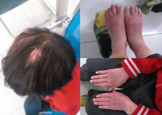 又见虐童！安徽11岁女孩遭母亲殴打 头部渗血