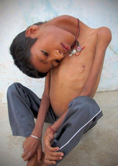 印度男童患怪病 头180度倒挂胸前无法站(图/慎)