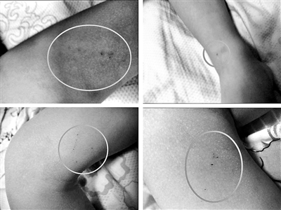 北京3岁男童疑遭针扎10处 幼儿园:螨虫咬的