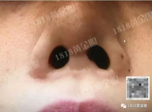 姑娘为整容打失踪孩子 鼻孔被整成“猪八戒”(图)