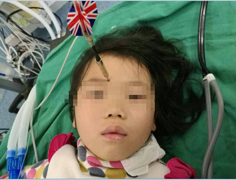 熊孩子！7岁哥哥玩飞镖 正扎进妹妹眉心