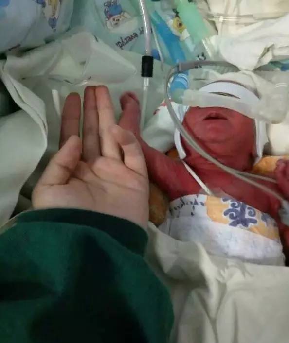 贵州早产女婴仅有成人手段大 事业存活