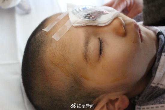 6岁男童遭继母棘手75%颅骨缺损 已吸收眼部手术